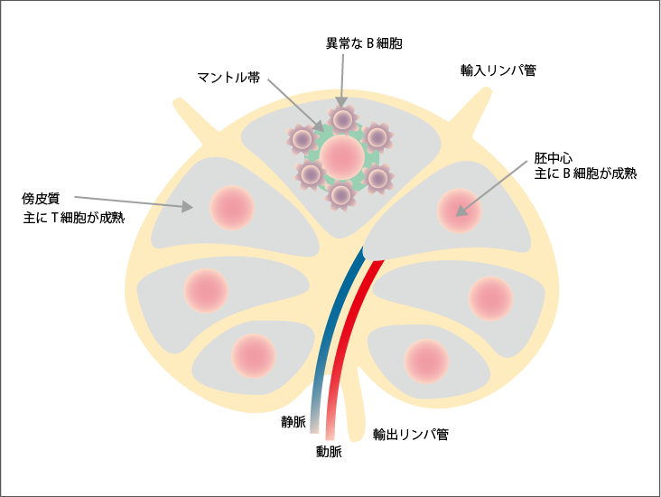 マントル細胞リンパ腫