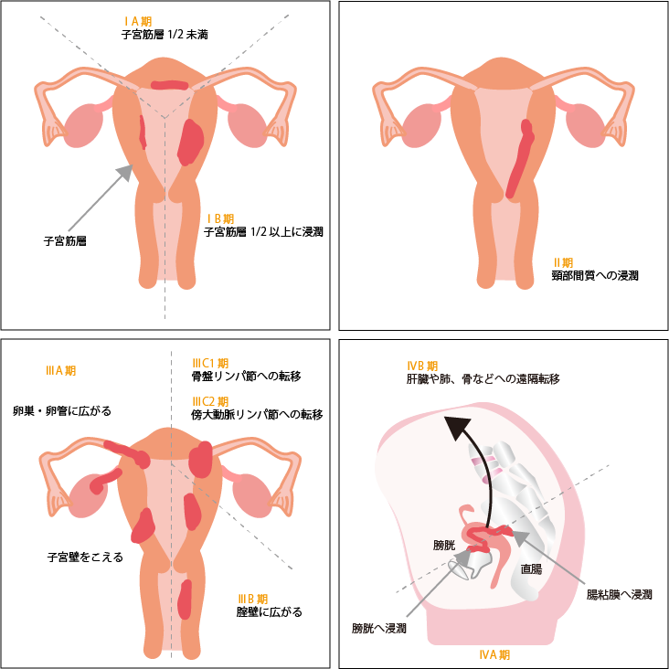 子宮体がんのステージ分類